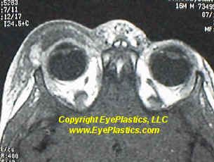 Preseptal periorbital cellulitis — eyelid swelling and erythema