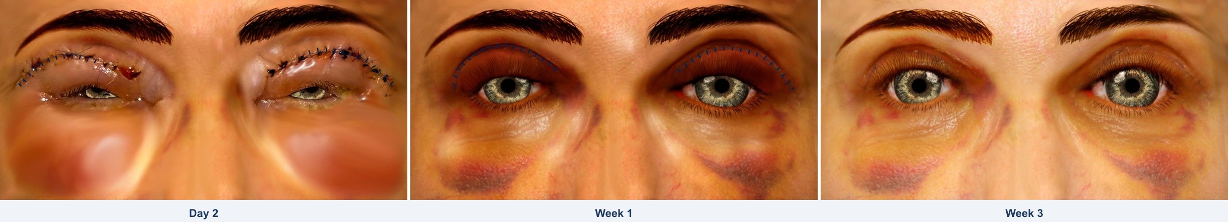 Patient applying cold compress to eyelids after blepharoplasty surgery