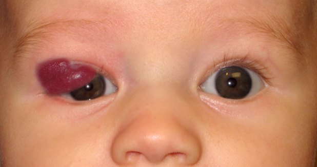 Hemangioma Response to Timolol Over Time โ slide 1 of 8