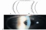 Punctate lesions - A medical image showing punctate lesions with opacity: 0.7.