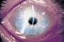 Photograph showing Corneal pannus