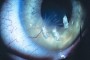 Image showing filamentary keratopathy