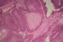Histological image showing cells from a Sebaceous Cell Carcinoma