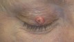 Photograph of a Keratoacanthoma on the Right Upper eyelid.