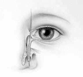 Step 1 - Pediatric LacriCath