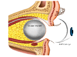 artificial eye Anophthalmos - Cosmetic & reconstructive surgery