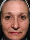 Before and after comparison pamphlet for Thermage treatment