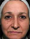 Before image showing the effects of Thermage treatment