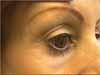 A promotional pamphlet displaying the results after undergoing Thermage treatment.