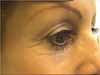 Before image showing the condition prior to the Thermage treatment