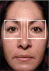 Before photo of a person undergoing Thermage treatment