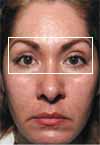 A person appearing younger after undergoing a Thermage treatment.