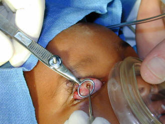 Chalazion surgery procedure