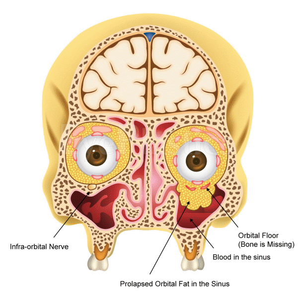 Orbital Fracture Orbital Fracture