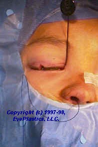 Image depicting canalicular trauma. The image contains medical illustrations showing the anatomy of the lacrimal canalicular system.