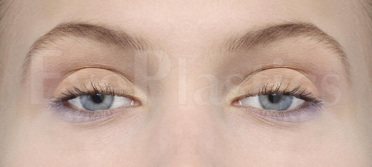 Photograph of a person with ptosis, showing drooping of the upper eyelid over the eye