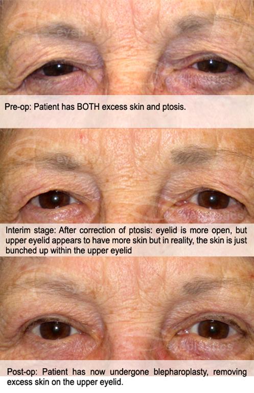 Image showing a patient with ptosis before and after blepharoplasty surgery. The image includes labeled diagrams indicating the surgical incisions and corrections made.