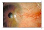 A medical image showing symblepharon. Width: 229 pixels, Height: 158 pixels