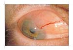 Image of symblepharon medical condition