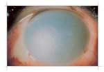 Image of an eye condition called Symblepharon, showing the adhesion between the eyelid and the eyeball
